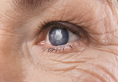 Closeup of a woman's eye with cataracts