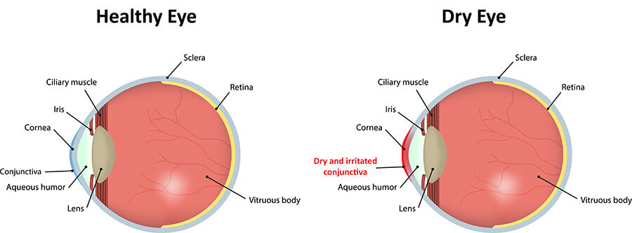 Chart Showing How Dry Eyes Affects the Eye